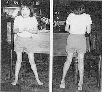 Se pierde la movilidad en piernas